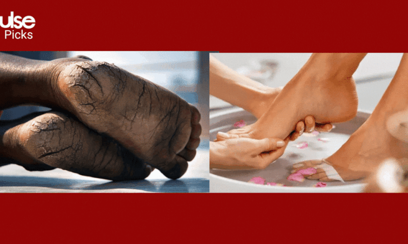 Remedies for cracked feet