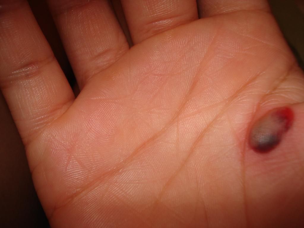 Blood blister close-up  by Esinam