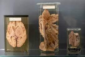 Sarah Baartman's remains displayed in Paris [Oudtshoorn]