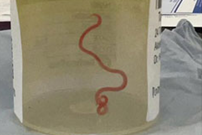 A live worm was found in a women's brain [skynews]
