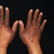 Staying close to a major road can cause eczema [Nationaleczemaassociation)