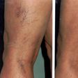 6 simple things spider veins are telling you to do