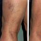 6 simple things spider veins are telling you to do