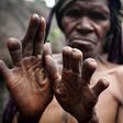 The finger-cutting as a mourning practice of the Dani People [Guardian]