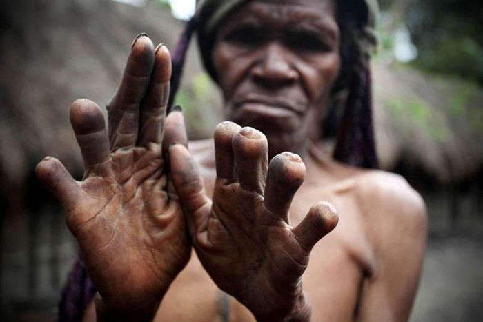 The finger-cutting as a mourning practice of the Dani People [Guardian]