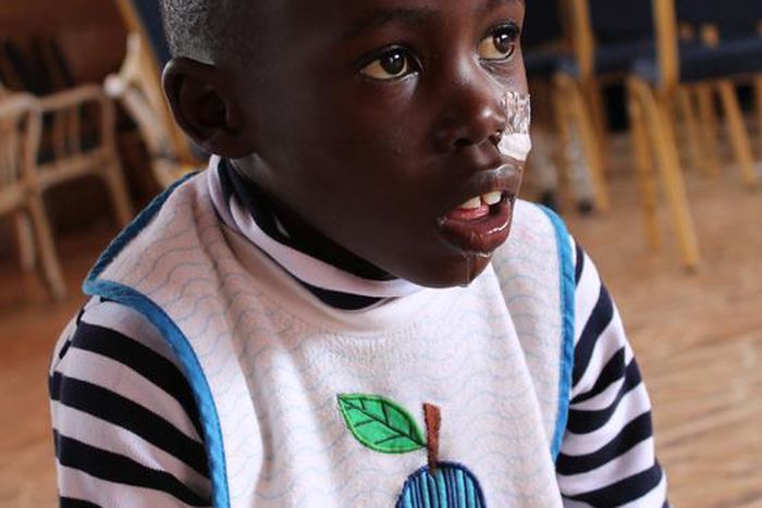 Kid with sickle cell [Anadolu Ajansı]