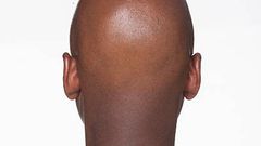 What makes men go bald in their 20s [istockphoto]