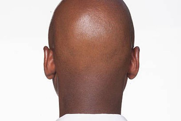 What makes men go bald in their 20s [istockphoto]