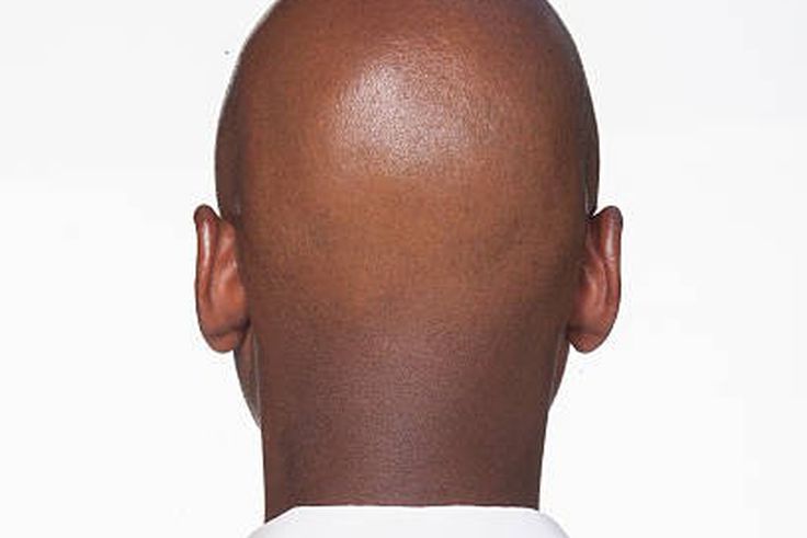 What makes men go bald in their 20s [istockphoto]