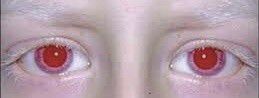 Red eyes in albinos [Quora]