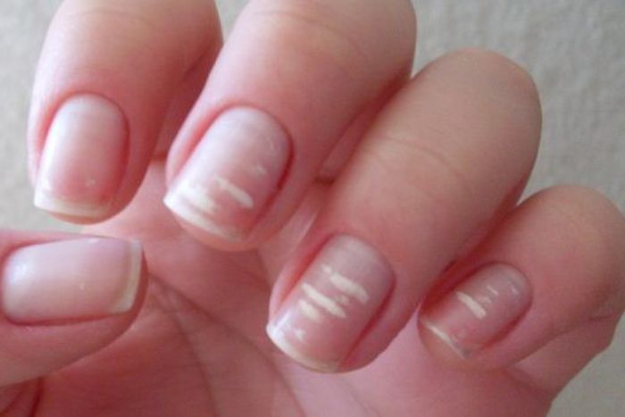 White marks on nails- Marine Healthfoods