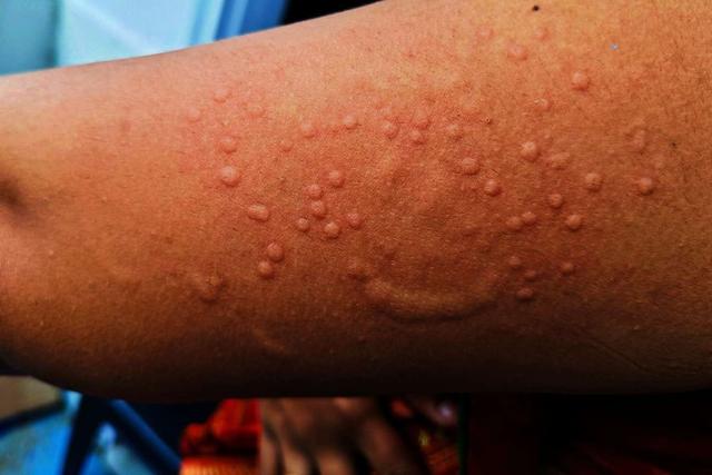 Symptoms of Mpox
