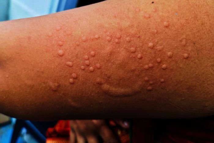 Symptoms of Mpox