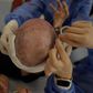 Spencer Macnaughton during his hair transplant in Istanbul TurkeyKenny Wassus/Business Insider