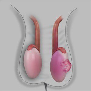Testicular cancer- Dr Troy Gianduzzo