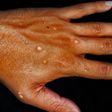 Monkeypox on a hand-Healthdirect