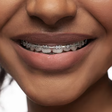 What are the signs you may need to get braces [Freepik]