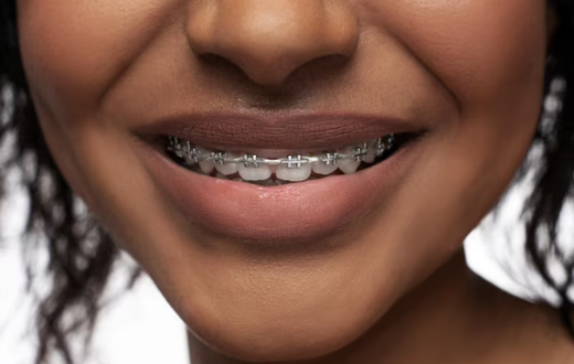 What are the signs you may need to get braces [Freepik]