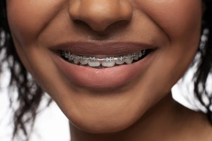 What are the signs you may need to get braces [Freepik]