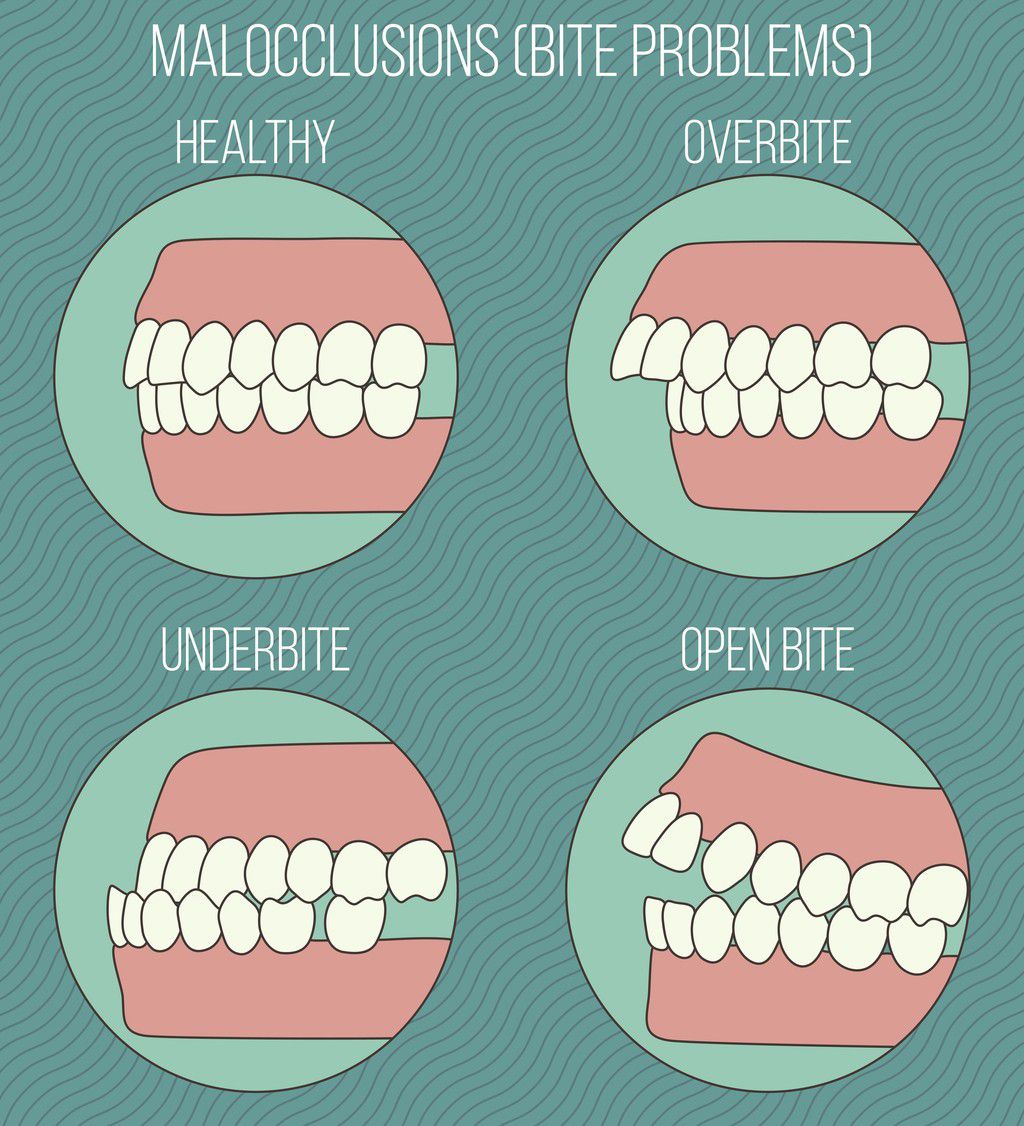 This condition is known as malocclusion [WoodSpringsDentist]