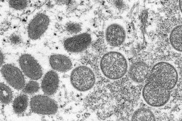 This electron microscopic (EM) image depicts monkeypox virus particles, obtained from a clinical specimen associated with the 2003 prairie dog outbreak. [Getty Images]