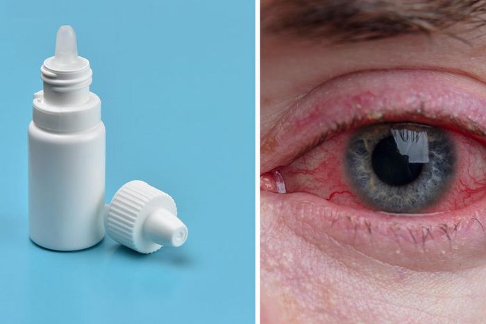 Signs of an eye infection include redness and pain.Getty Images