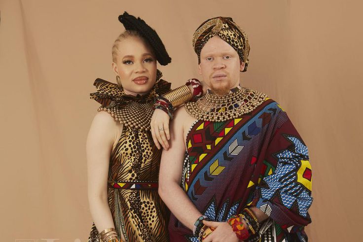 7 daily challenges people living with albinism in Nigeria face [Guardian]