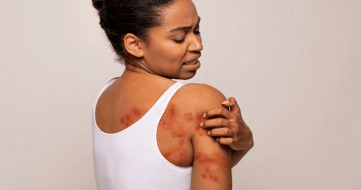 Beat the Heat: How to spot and treat heat rash | Pulse Nigeria