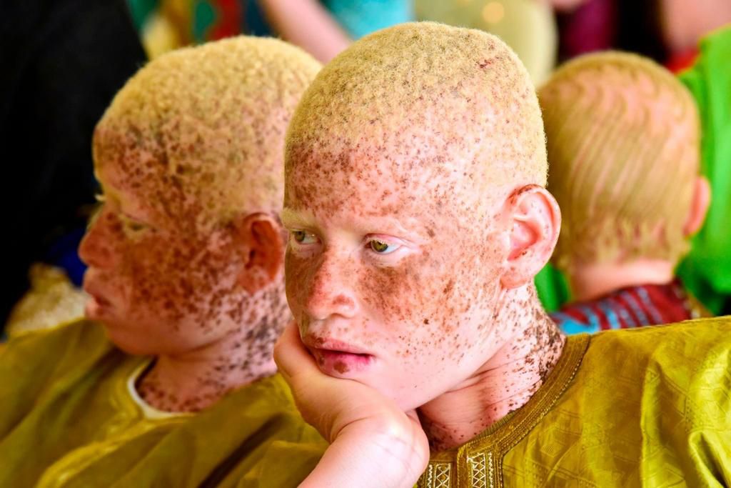 7 common myths about people living with Albinism [Getty Images]