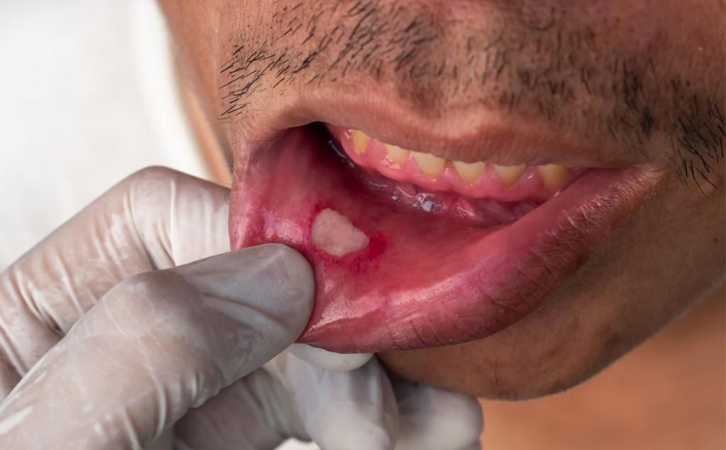 Canker sores [Health]