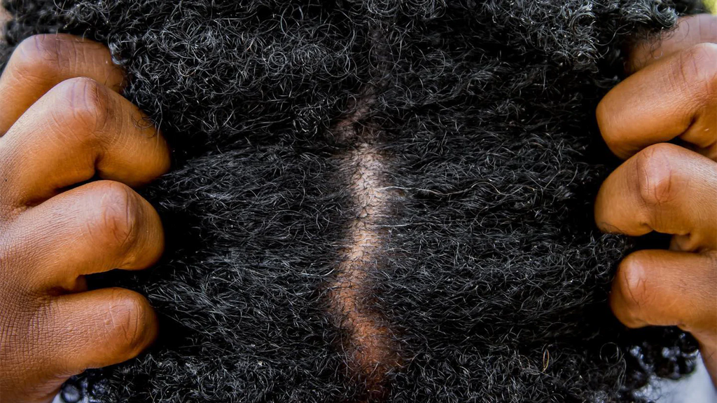 How to get rid of hair lice naturally [europeanwritertour]