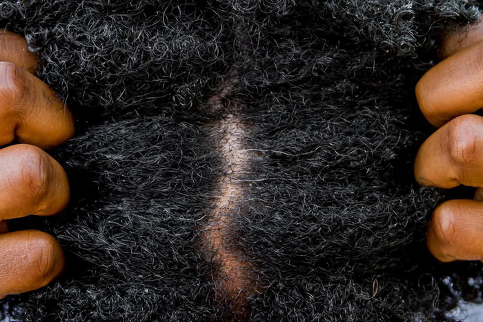 How to get rid of hair lice naturally [europeanwritertour]