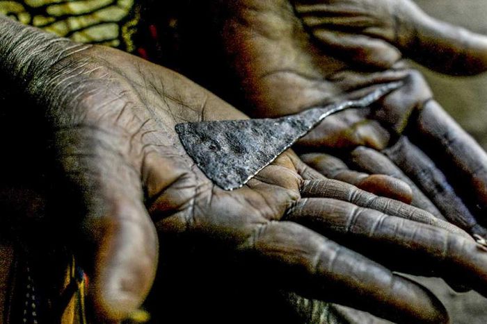 Female genital mutilation [healthline]