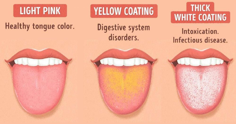 The colour of your tongue can indicate health issues [Breckenridge]