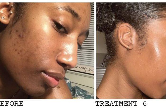 Applying saliva can treat pimples and acne scars [Pinterest]