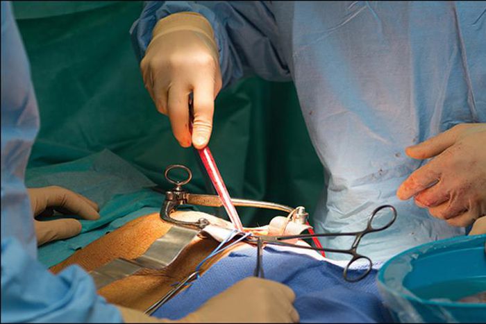 Kidney transplant [Dr. Vikas Agarwal]