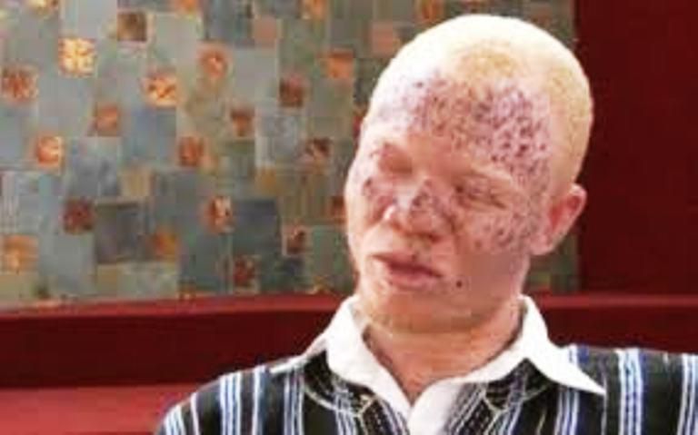 114 albinos have disappeared in Mozambique