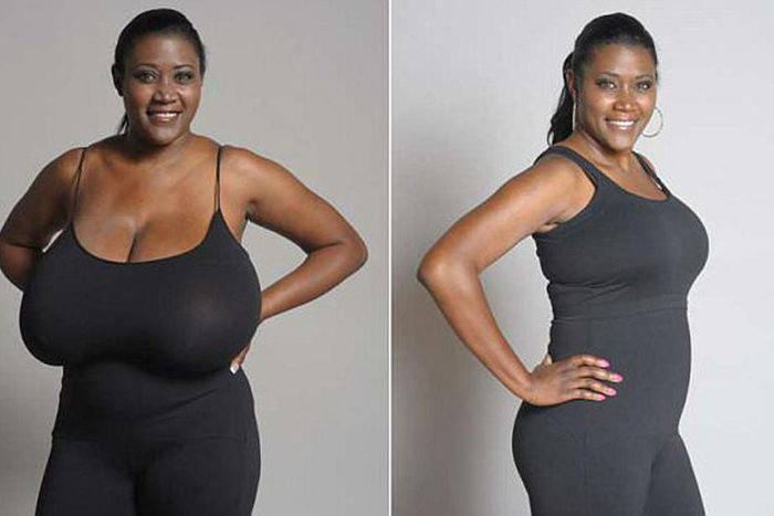 Facts about breast reduction surgery [reductionrhinoplasty]