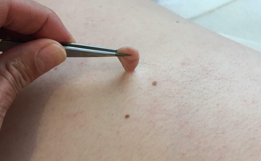 Skin tag removal [LolachiInstitute]