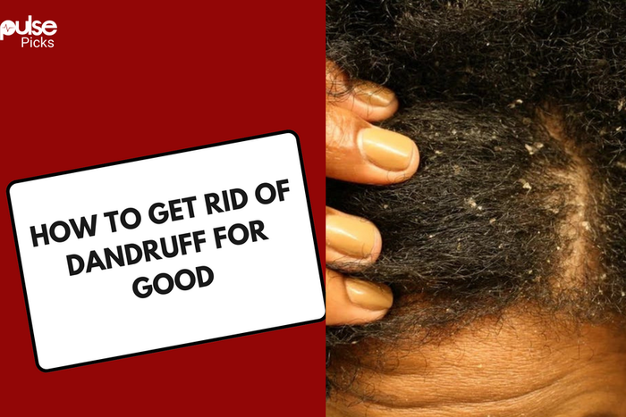 How to get rid of dandruff for good