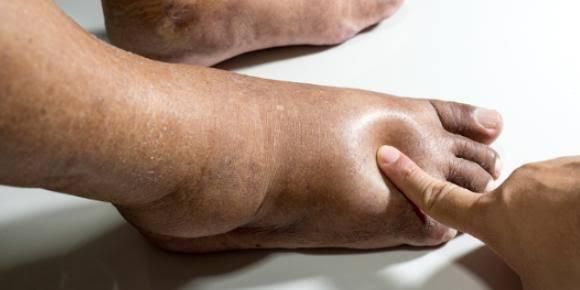 Leg swelling is also known as edema [Shutterstock]