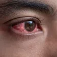 Sudden red eye in the morning could be a sign of conjunctivitis [Depositphotos]