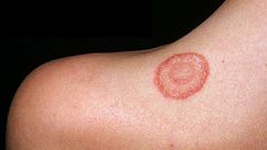 What causes ringworm? [Medicircle]