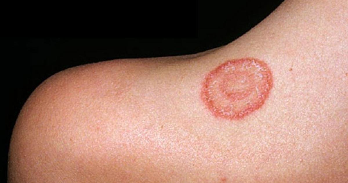 9 fast and effective remedies for treating ringworm at home | Pulse Nigeria