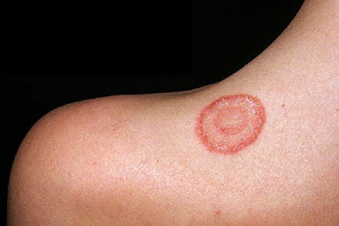 What causes ringworm? [Medicircle]