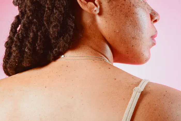 Why do skin tags develop? [Self]