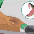 Should you suck the venom out of a snakebite? [myUpchar]