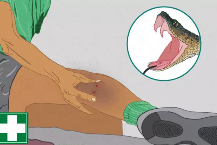 Should you suck the venom out of a snakebite? [myUpchar]