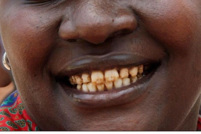 Drinks that stain your teeth [X]