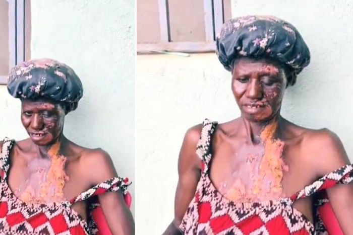 Mother left with severe burns after 14-year-old daughter poured hot water on her